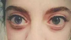 真实的金鱼眼是什么样子图片,范冰冰是金鱼眼吗?